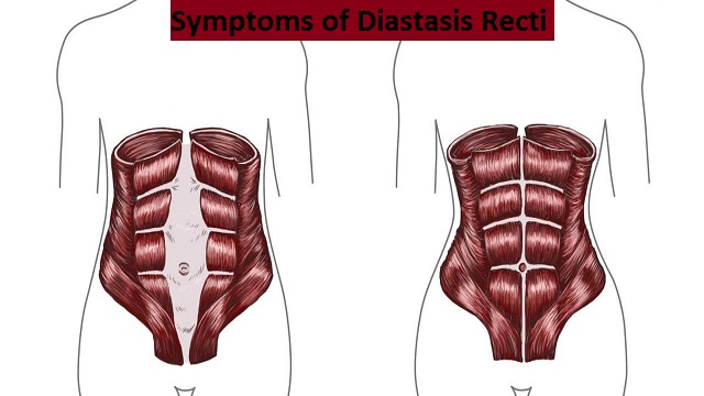Symptoms of Diastasis Recti